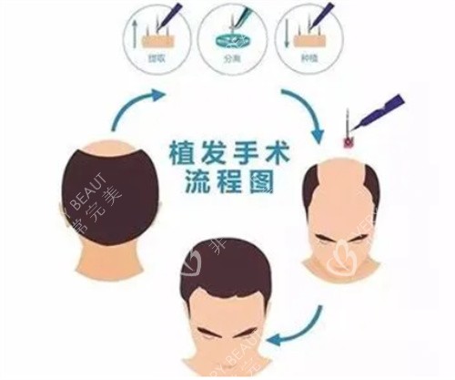 最新植发技术揭秘，小巷中的美发宝藏